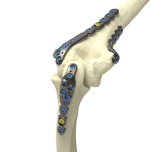WINSTA E: Système de plaques pour les fractures de coude ...